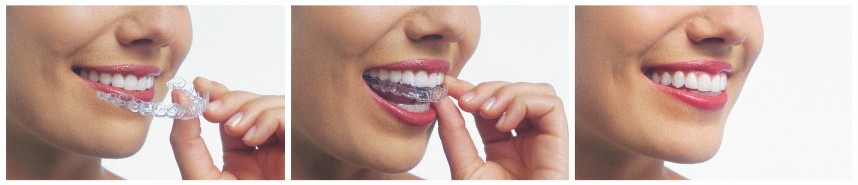 Invisalign services at Haddon dentistry